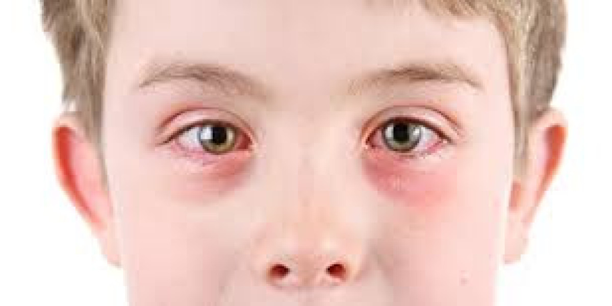 Allergic Conjunctivitis Treatment Market Size, Share, Trends, Growth, Analysis, Report and Forecast 2024-2032