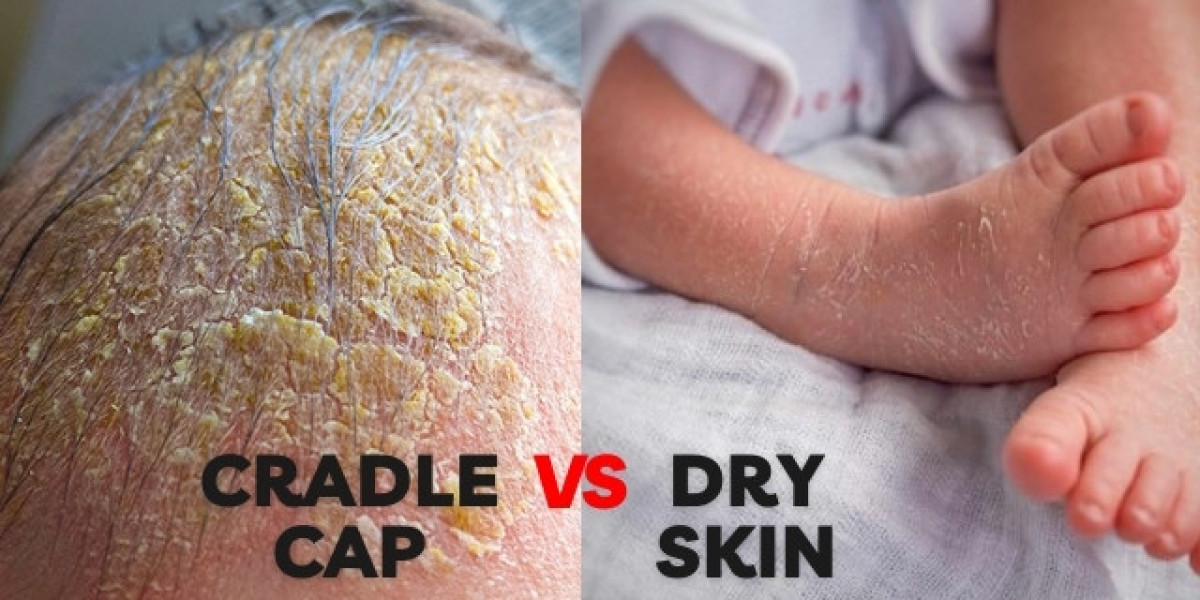 Baby's Scaly Surprise: Unveiling Cradle Cap vs. Dry Skin