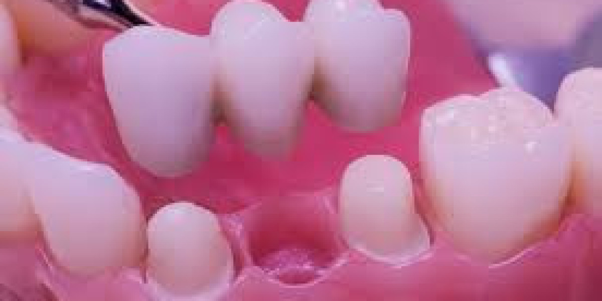 Factors to Consider When Choosing Dental Fillings