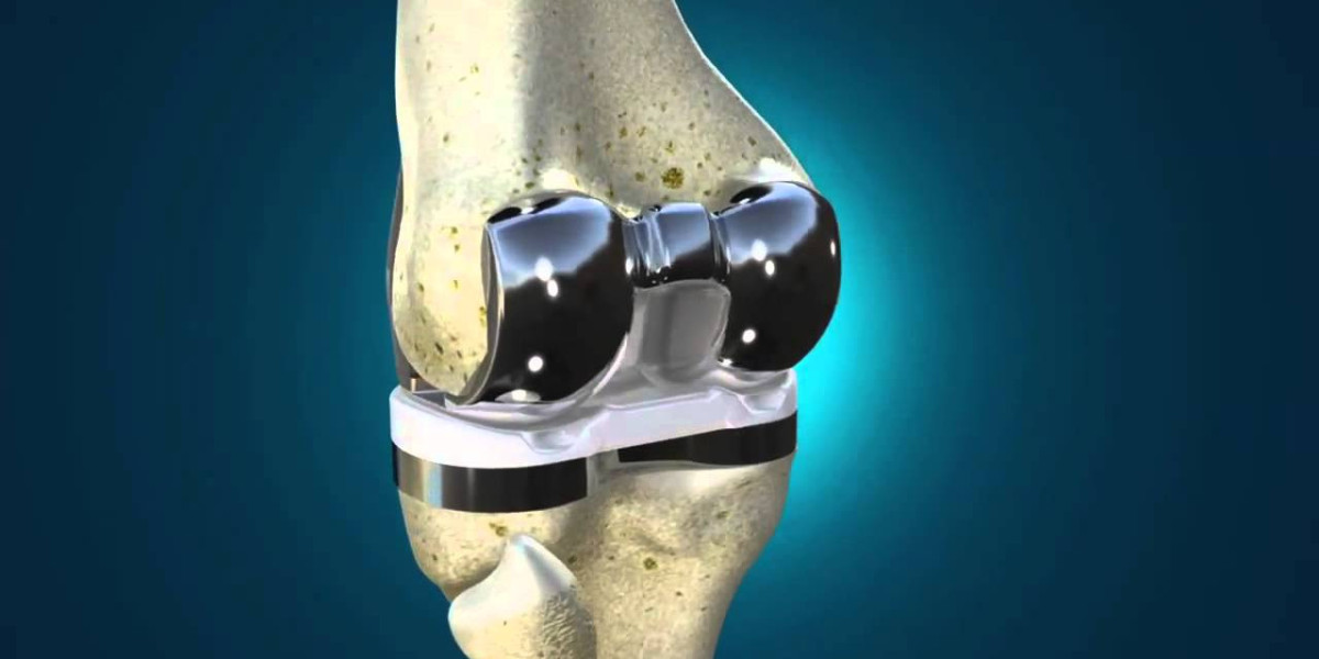 Knee Implant Market Size, Share, Growth Drivers, Key Expansion and Forecast 2030