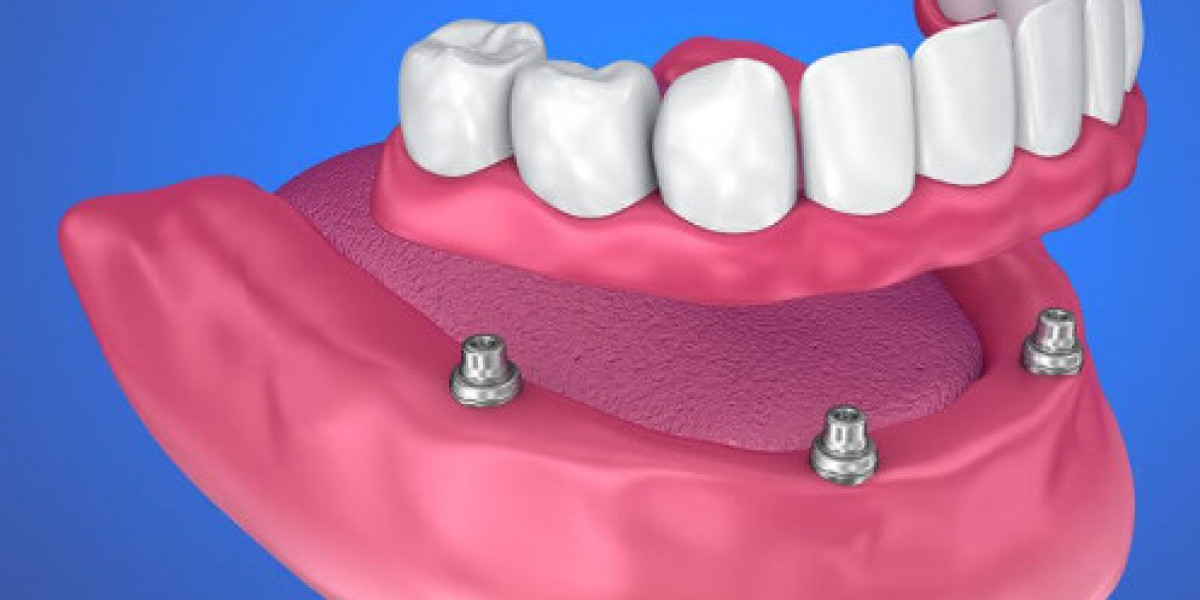 Making Informed Choices: Dentures and Dental Implants