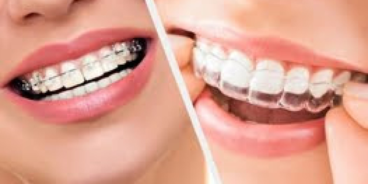 Transform Your Smile with Invisalign Braces in Bangalore: The Clear Path to Perfect Teeth