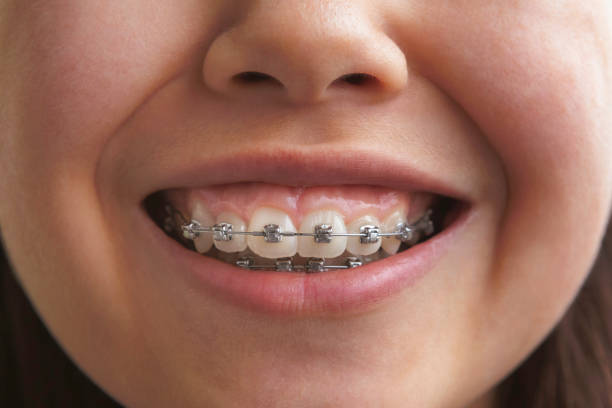Is Your Child Ready for Braces? 4 Signs and Early Intervention | Ladera Orthodontics