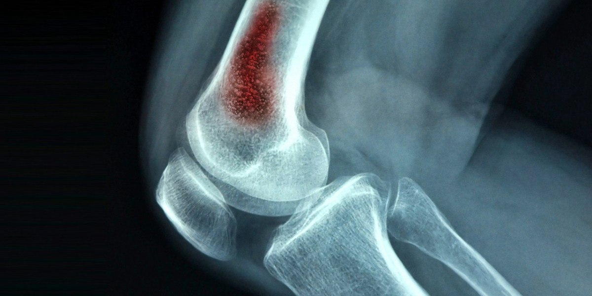 2024, Osteomyelitis Market | Industry Analysis Till 2034
