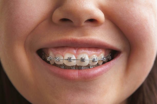 Is Your Child Ready for Braces? 4 Signs and Early Intervention