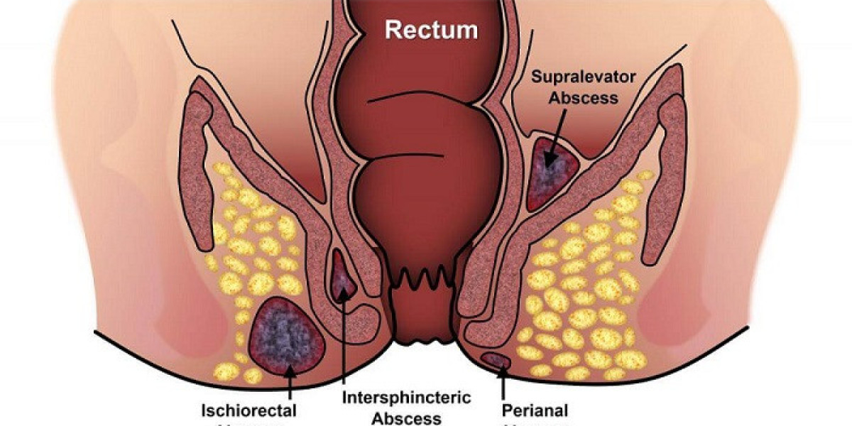 Mastering Fistula Surgeon Mumbai: Insights from Mumbai's Leading Surgeon