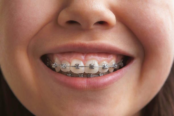 Is Your Child Ready for Braces? 4 Signs and Early Intervention | by Laderaorthoca | Jul, 2024 | Medium