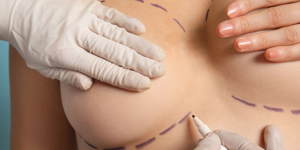 Achieving Symmetry with Breast Enhancement Fat Transfer