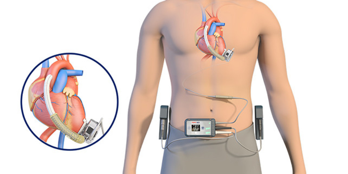 Ventricular Assist Devices Market Segments, Growth, Size, Share and Forecast 2024-2032