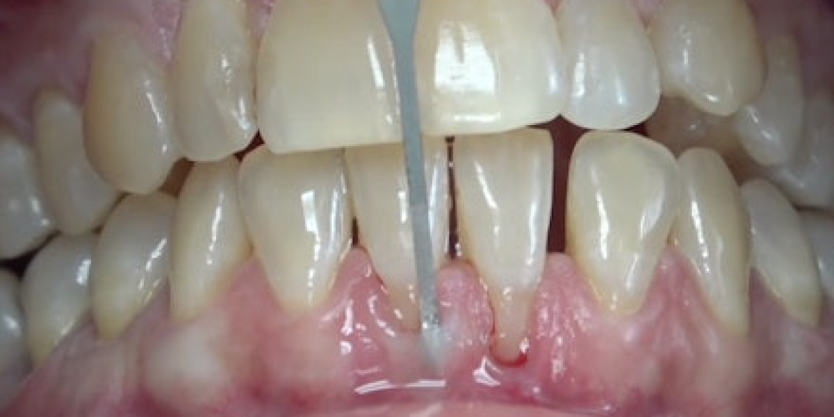 Creating Beautiful Smiles: The Intersection of Ridge Augmentation and Digital Design