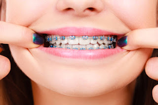 What Should You Anticipate for Your First Appointment for Braces?