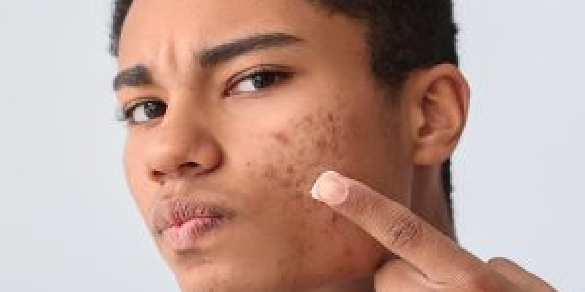 How to Deal with Cystic Acne