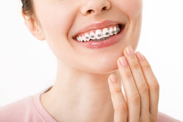 Benefits of braces