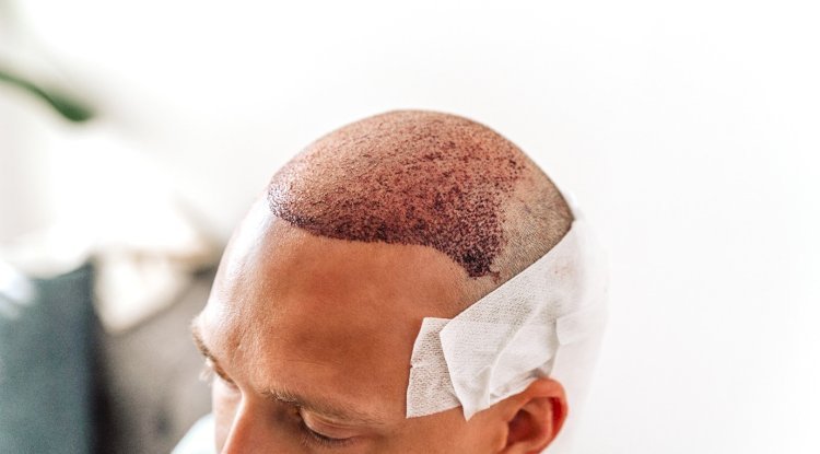 Important Considerations to Choose a Reputable Clinic for Hair Transplant in Dubai - Free instant approval guest posting Website