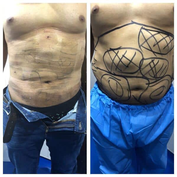 Liposuction In Lahore - Dr. Ata Best Plastic Surgeon